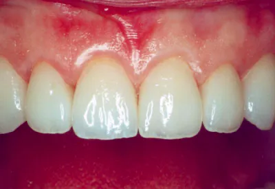 Porcelain Veneers