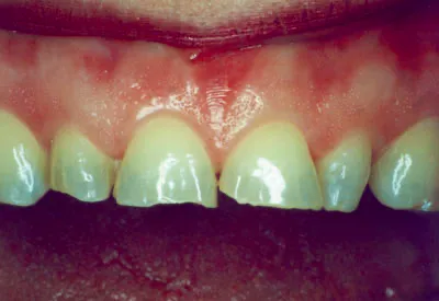 Porcelain Veneers