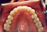 Tooth Colored Fillings