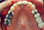 Tooth Colored Fillings