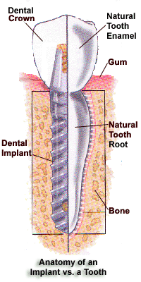 Dental Implants